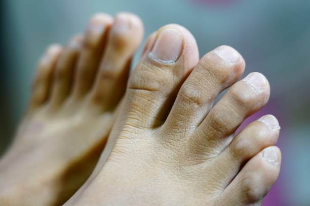 지독한 발 냄새 원인