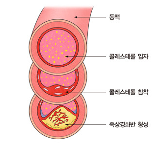 대동맥 죽상경화증