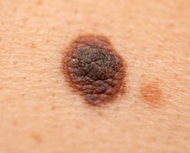 피부암 종류별 초기증상 10가지 및 흑색종 점모양 영상 피부암 수술사례