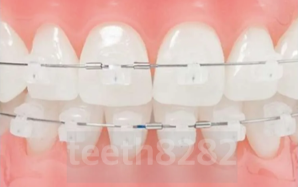 일반교정-데이몬교정-비교