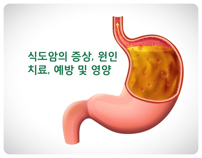 식도암의 증상&#44; 원인&#44; 치료&#44; 예방 및 영양