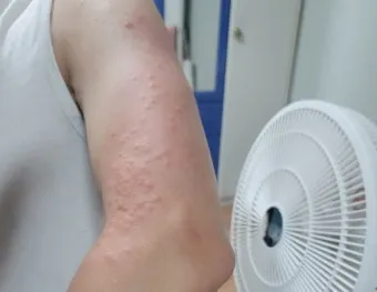 쇠파리에 물리면 증상 대처법과 응급처치 방법 안내_24