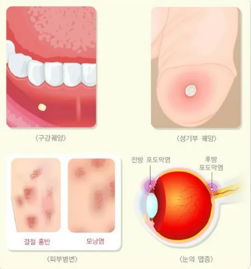 베체트-병-발생부위