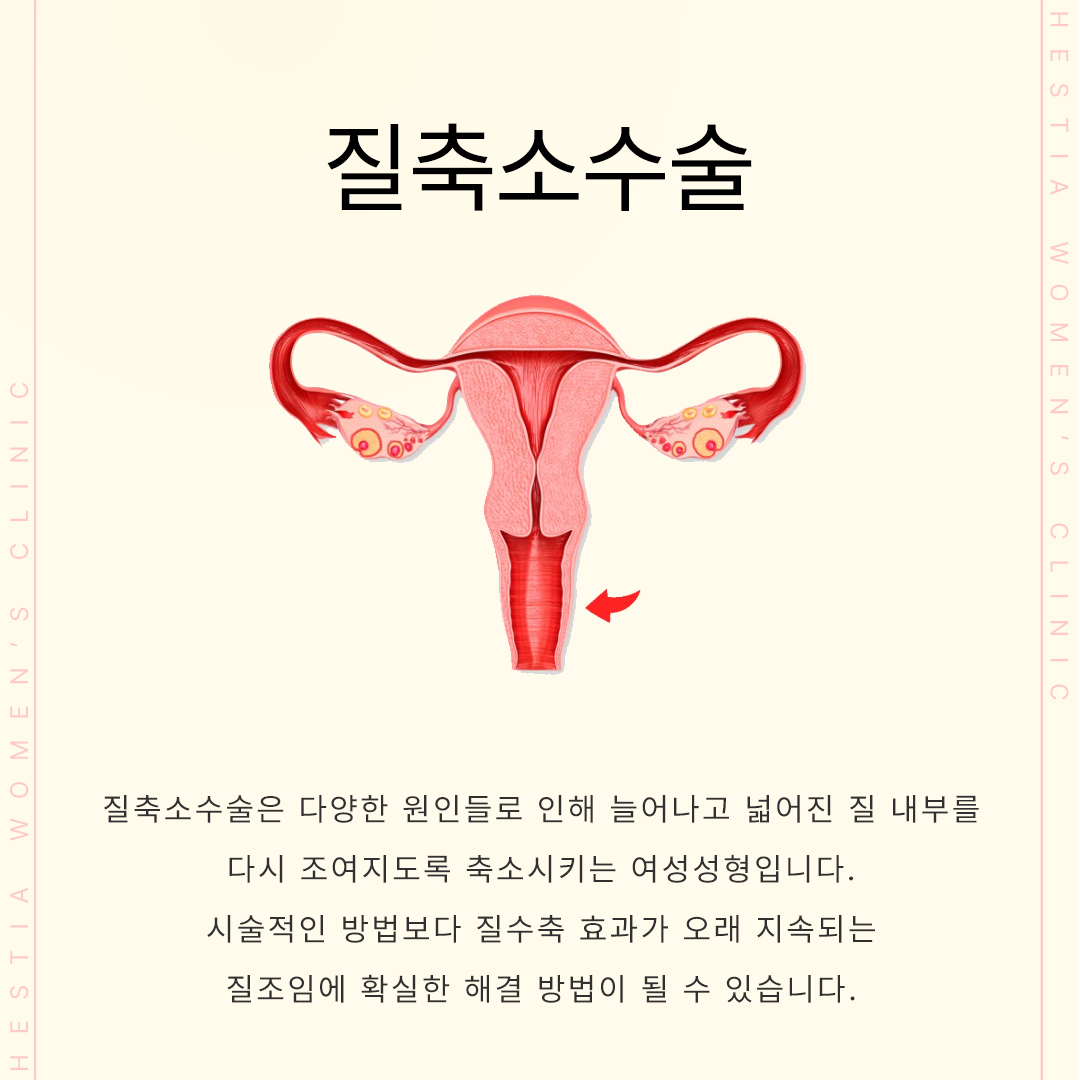 질성형
질수축