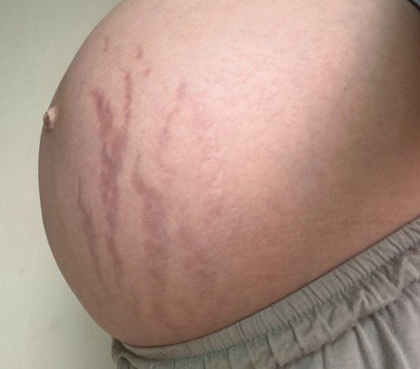 [임신 26주] 쌍둥이 임신 배 튼살, 바세린&middot;사봉 바디스크럽&middot;클라랑스 크림 후기