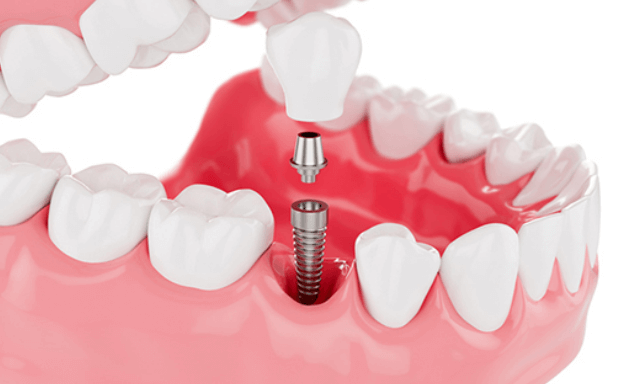 임플란트-주위염-치료하는-3가지-방법