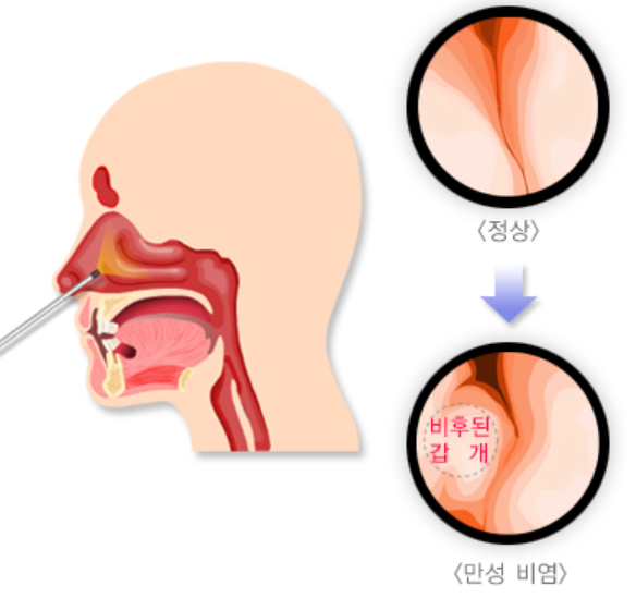 비염 증상, 비염 치료방법 섬네일