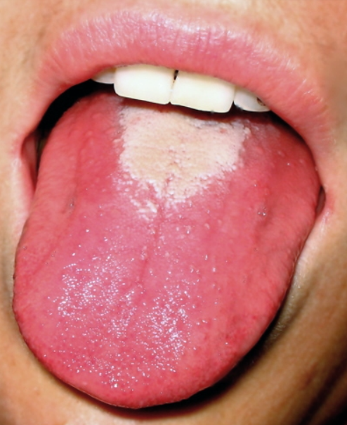 [감염병 주의] 성홍열 증상 및 감염 경로, 예방 방법