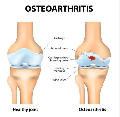 건강한 무릅과 관절염을 겪는 무릅비교