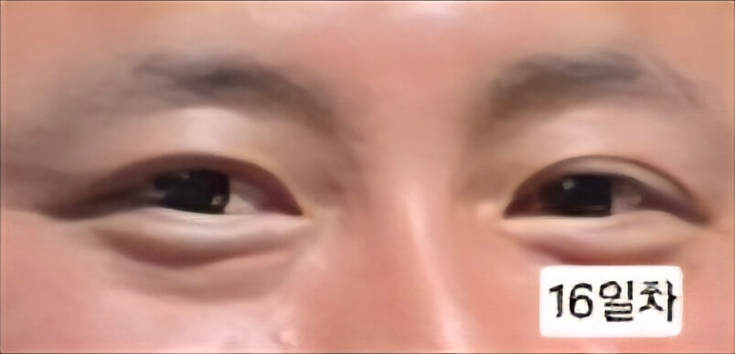 유행성각결막염 치료과정 증상 시력저하 회복과정 발병2주 3주 기록