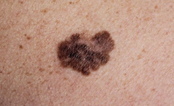 흑색종 점모양 피부암 수술사례