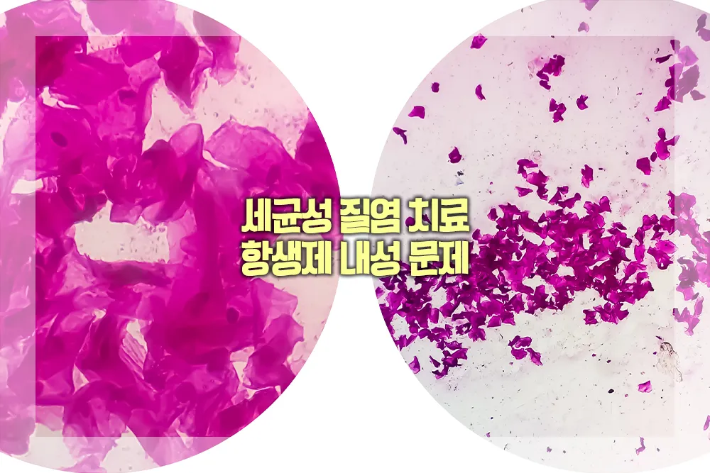 세균성 질염 치료 항생제 내성 문제