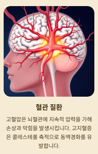 뇌경색의 원인