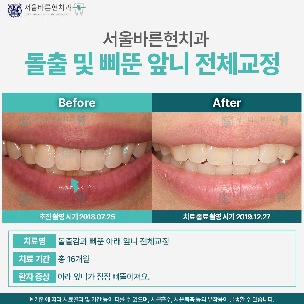 해운대치아교정