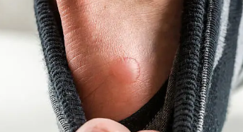 저온화상 초기 대응