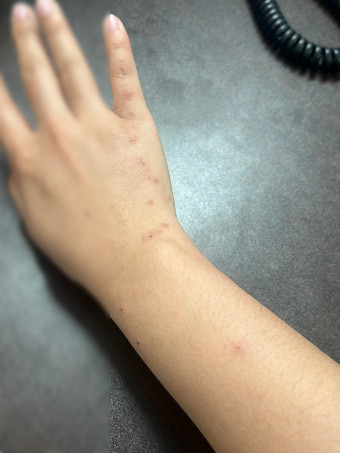 쯔쯔가무시병의 증상과 치료