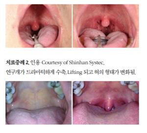 코골이