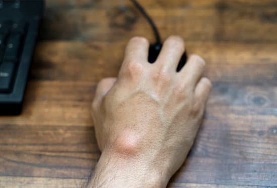 손의 결절종(Ganglion Cyst): 원인, 증상 및 치료 방법