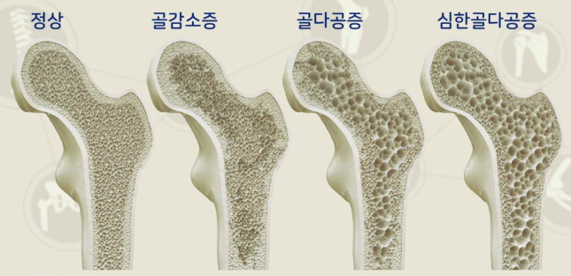 골다공즐 진행 과정
