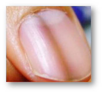 손톱 검은 세로줄2