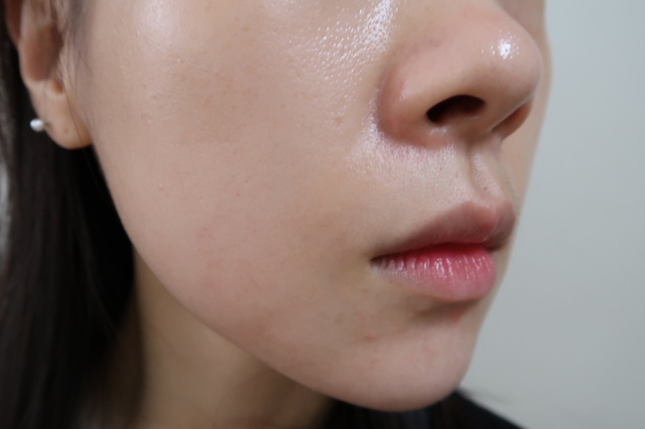 bbl 레이저 후기