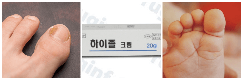 하이졸크림, 아기 무좀 사진