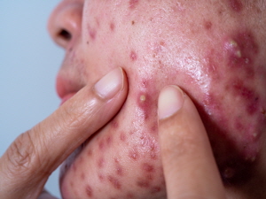 여드름 흉터 없애는법
