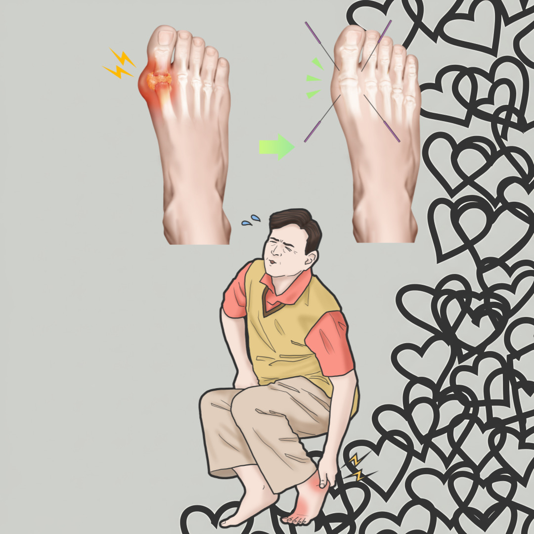 요산 관련 통풍 그림