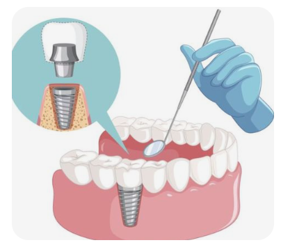 임플란트-보험-적용-확인