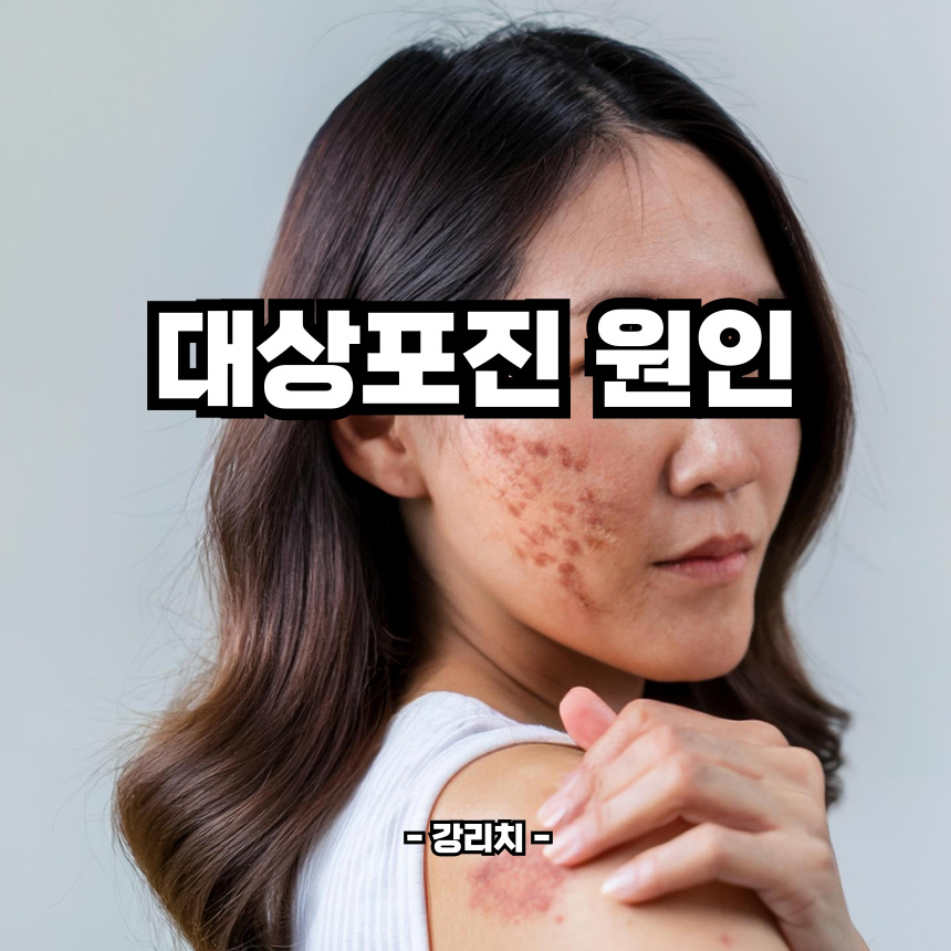 대상포진 원인