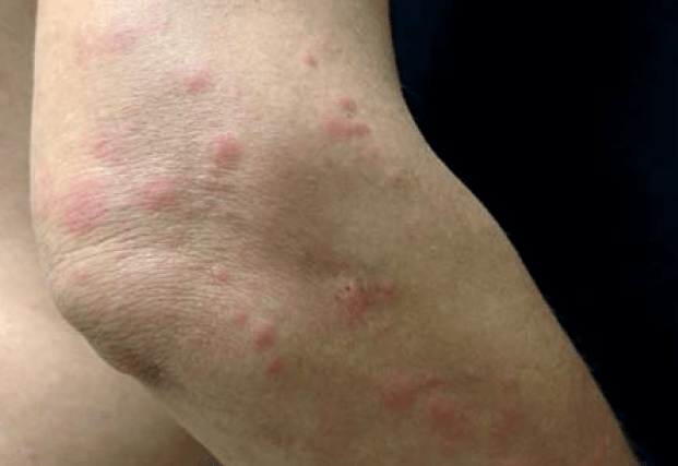 빈대 퇴치법과 효과적인 빈대 퇴치제