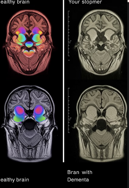 치매란? 그리고 원인은?