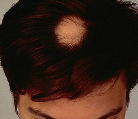 탈모 종류 중 원형탈모