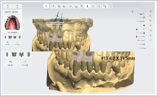 전체임플란트잘하는곳-전체임플란트치과고르는법-전체임플란트가격-시술후기