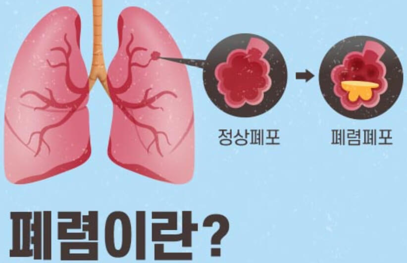 폐렴, 우리에게 친숙하지 않은 그 질병: 폐렴에 대한 전반적인 이해