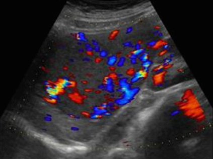 hepatocellular adenoma (간세포선종)