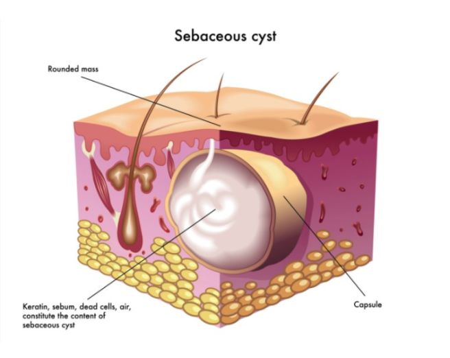 종기가 생기는 이유