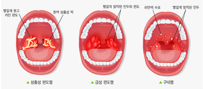 편도선