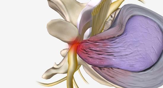 추간공 감압술(Foraminotomy)에 대한 이해