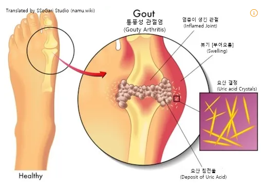 통풍