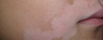 백반증 초기증상 2