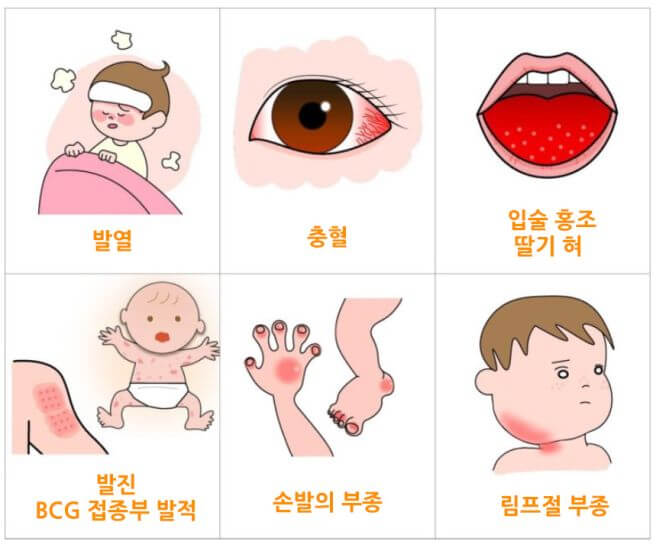 가와사키병 증상