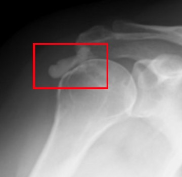 석회성 건염 치료