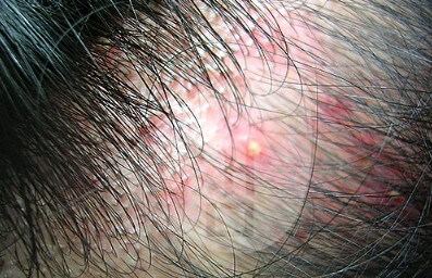 지루성 두피염으로 두피가 곪은 모습