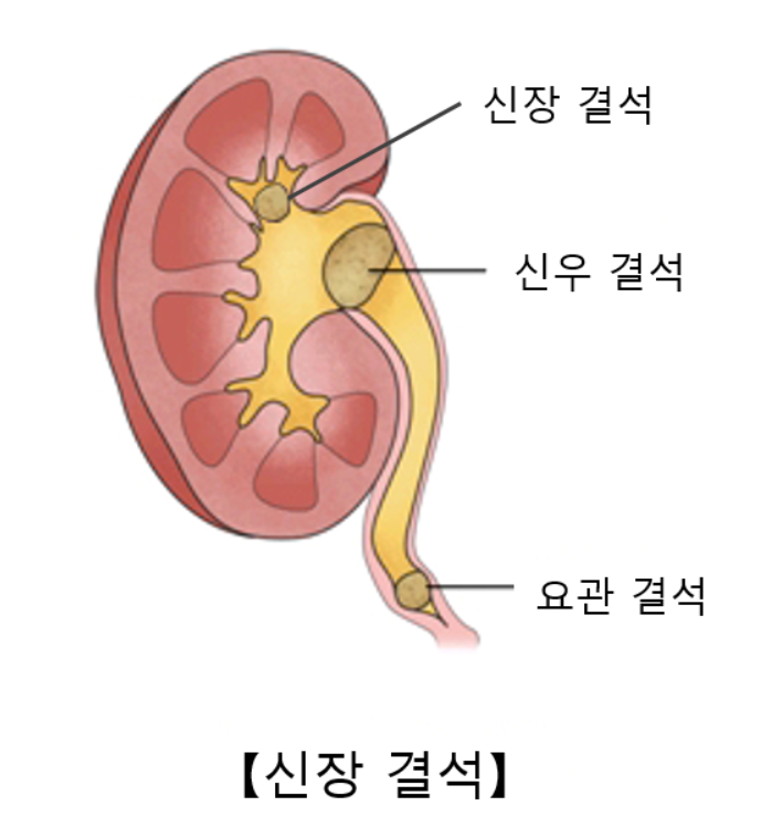 요로 결석 설명 사진
