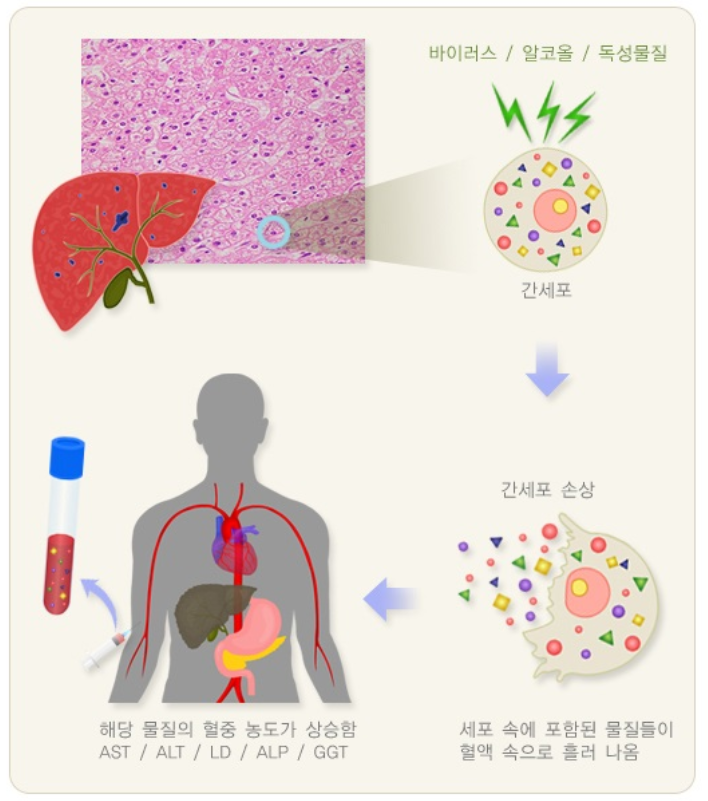 간수치 높아지는 원인