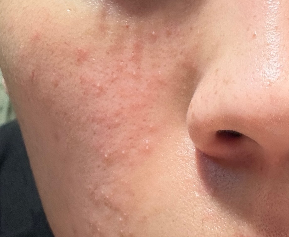 여드름이 나타난 얼굴