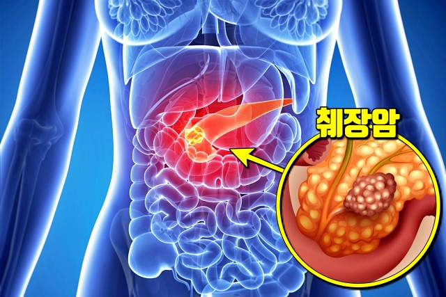 췌장암 증상,췌장암 초기증상,췌장암 자가진단,팁줌