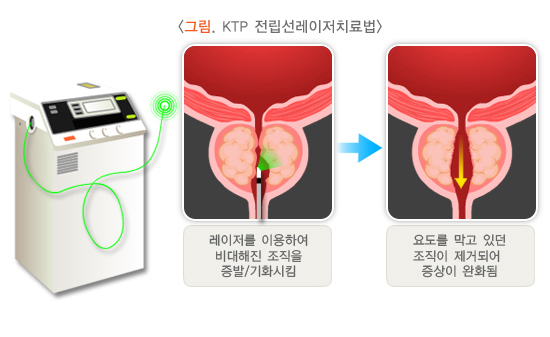 전립선레이저치료법을-표현한-그림