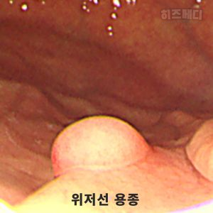 위저선 용종